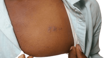 Tattoo Removal-image